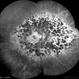 Tapetoretinal Degeneration