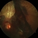 Proliferative Diabetic Retinopathy (PDR) Proliferative Diabetic Retinopathy (PDR)