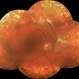 Proliferative diabetic retinopathy Proliferative diabetic retinopathy