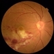 Retinal Ischemia, Edema, and Hemorrhages on the Infero-Temporal Macula