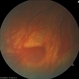 Varices OD Prominent Vortex Vein Ampulla Varices OD Prominent Vortex Vein Ampulla
