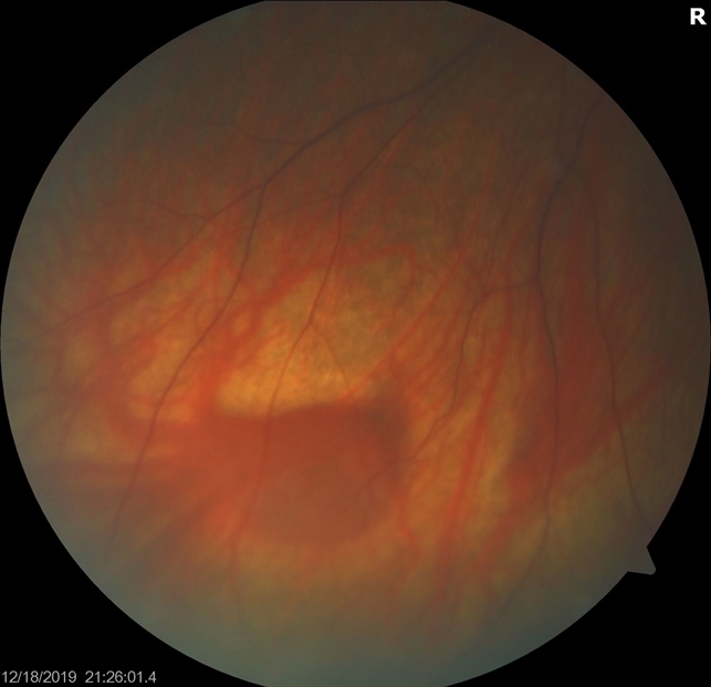 Varices OD Prominent Vortex Vein Ampulla - Retina Image Bank