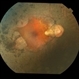 Gyrate Atrophy of Choroid and Retina