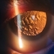 Posterior Subcapsular Cataract Posterior Subcapsular Cataract