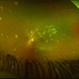 Choroidal Miliary Tubercles