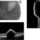 Valsalva Retinopathy