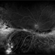 Exudative Retinal Detachment and Branch Retinal Vein Occulsion Exudative Retinal Detachment and Branch Retinal Vein Occulsion