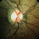 ANGIOID STREAK WITH PXE ANGIOID STREAK WITH PXE