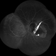 RPE rip in a case of Idiopathic polypoidal choroidopathy