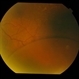 Bilateral Senile Retinoschisis