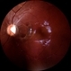 Choroidal Rupture Choroidal Rupture