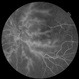 Branch Retinal Vein Occlusion-Posterior Hyaloid Proliferation