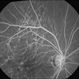 Chorioretinal Folds Orbital Tumor