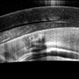 Luxated lens to anterior segment