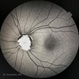Optic Disc Drusen