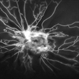 Severe Proliferative Diabetic Retinopathy Severe Proliferative Diabetic Retinopathy