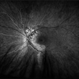Choroidal Hemangioma Choroidal Hemangioma
