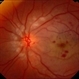 Color Fundus Photograph of Macular Infarction Secondary to Subonjunctival Gentamicin Injection Color Fundus Photograph of Macular Infarction Secondary to Subonjunctival Gentamicin Injection