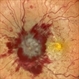 Idiopathic Intracranial Hypertension Idiopathic Intracranial Hypertension
