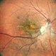 Dengue Maculopathy Resolving Dengue Maculopathy Resolving
