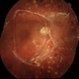 Preretinal Fibrosis Preretinal Fibrosis