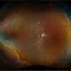 Uveal Effusion Syndrome Uveal Effusion Syndrome