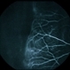 Combined Retinal / RPE Hamartoma Combined Retinal / RPE Hamartoma