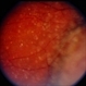 Choroidal Melanoma With Vitreous Seeding Choroidal Melanoma With Vitreous Seeding