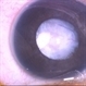 Tunica Vasculosa Lentis Tunica Vasculosa Lentis