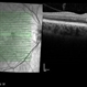 Paracentral Acute Middle Maculopathy OCT Paracentral Acute Middle Maculopathy OCT