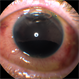 Hyphema