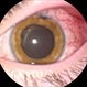 Choroidals/Serous Retinal Detachment
