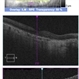 Pentosan Polysulfate Maculopathy Pentosan Polysulfate Maculopathy