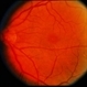 Macular Hole Evolving / Lamellar Hole Macular Hole Evolving / Lamellar Hole