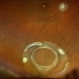 Dislocated Lens, Posterior OD Dislocated Lens, Posterior OD