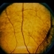Oguchi Disease Oguchi Disease