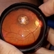 Central Areolar Choroidal Dystrophy Central Areolar Choroidal Dystrophy