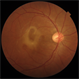 CSCR with Sub-Retinal Fibrin CSCR with Sub-Retinal Fibrin