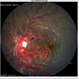 Wyburn-Mason- The Racemose Haemangioma
