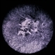 Wyburn-Mason Syndrome