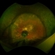Vitreous Cysts and Asteroid Hyalosis Vitreous Cysts and Asteroid Hyalosis