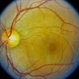 Central Serous Chorioretinopathy (CSR)