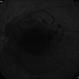 Early-FA-phase-of-macular-infarction-secondary-to-subconjunctival-gentamycin-injection Early-FA-phase-of-macular-infarction-secondary-to-subconjunctival-gentamycin-injection