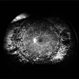 Regressed PDR following PRP and post RD repair with scleral buckle FA Regressed PDR following PRP and post RD repair with scleral buckle FA