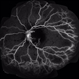 Acute Necrotizing Retinal Vasculitis as Onset of Systemic Lupus Erythematosus. Acute Necrotizing Retinal Vasculitis as Onset of Systemic Lupus Erythematosus.