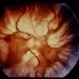 Retinal Detachment