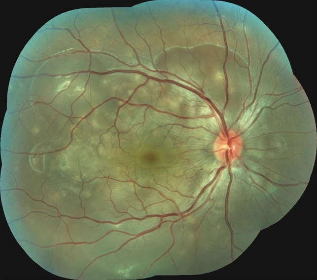 Vogt-Koyanagi-Harada Disease OD - Retina Image Bank