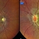 Pseudo Foster Kennedy Syndrome