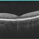 Autosomal Dominant Drusen of Bruch's Membrane, OCT Autosomal Dominant Drusen of Bruch's Membrane, OCT