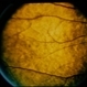 Oguchi Disease Oguchi Disease